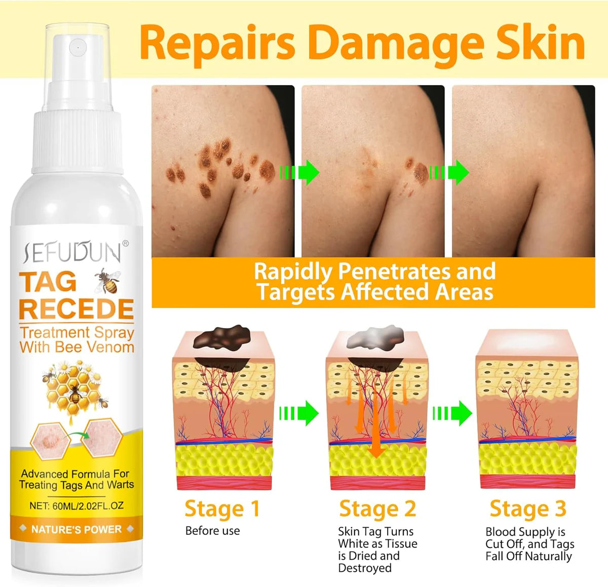 Tag Recede Eliminador de verrugas